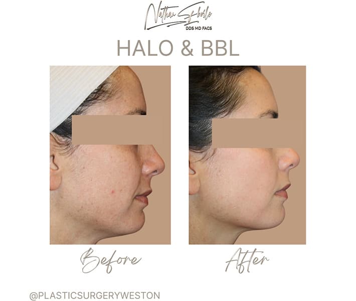 Halo Laser before and after case 7, actual patient at Weston Center for Plastic Surgery