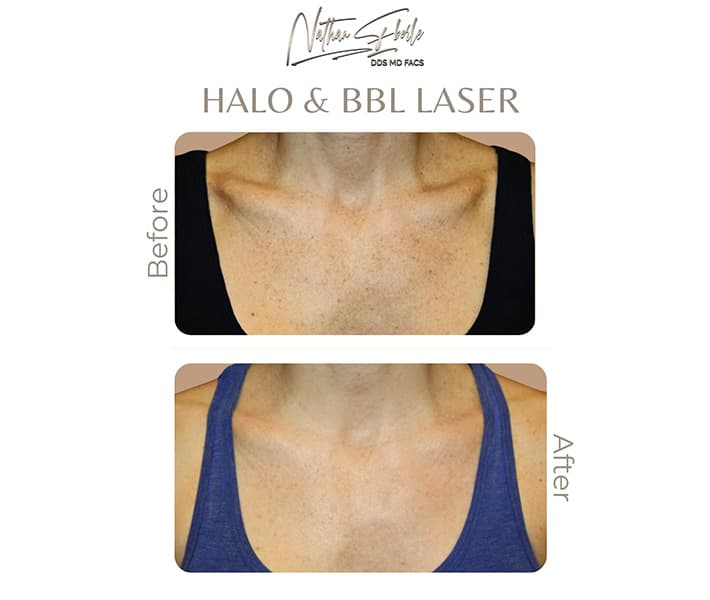 Halo Laser before and after case 8, actual patient at Weston Center for Plastic Surgery