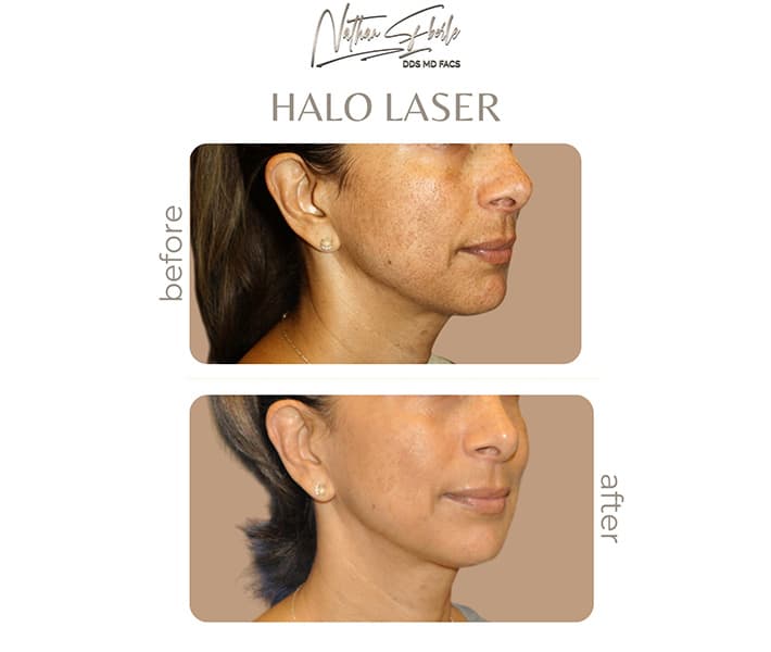 Halo Laser before and after case 9, actual patient at Weston Center for Plastic Surgery