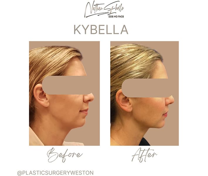 Kybella before and after result 1, actual patient at Weston Center for Plastic Surgery