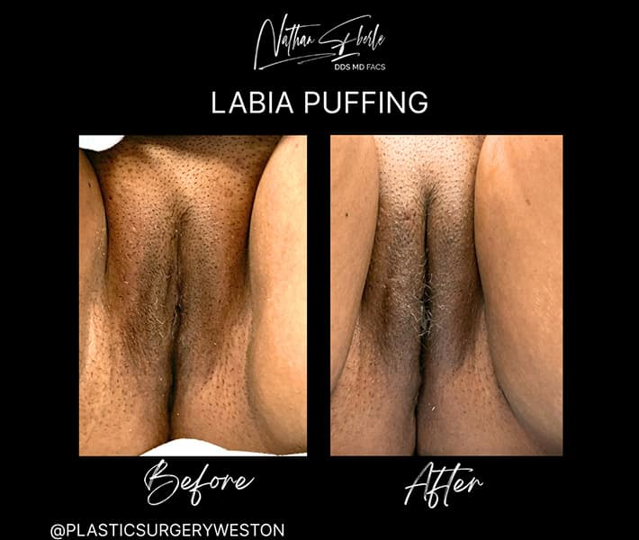Labia Puffing before and after result 1, actual patient at Weston Center for Plastic Surgery