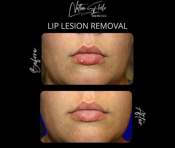 Lip Lesion Removal before and after result 1, actual patient at Weston Center for Plastic Surgery
