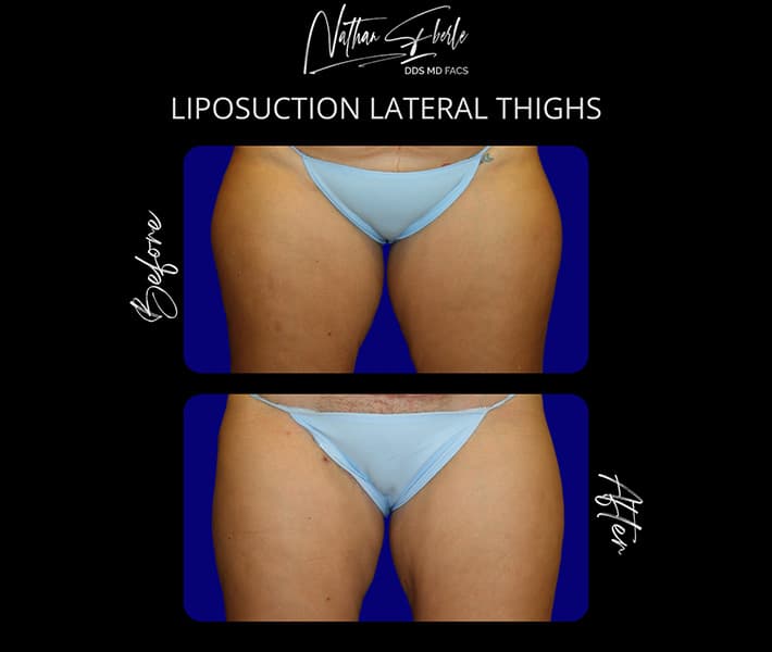 Liposuction before and after case 8, actual patient at Weston Center for Plastic Surgery