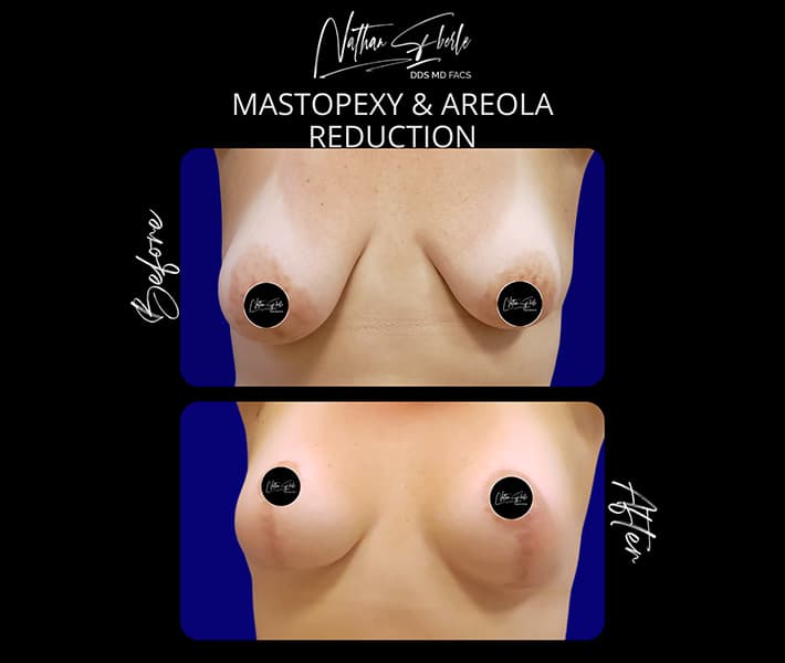 Mastopexy before and after result 1, actual patient at Weston Center for Plastic Surgery