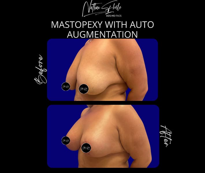 Mastopexy before and after result 2, actual patient at Weston Center for Plastic Surgery
