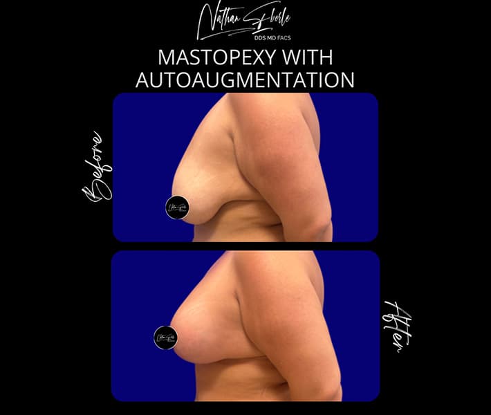 Mastopexy before and after result 3, actual patient at Weston Center for Plastic Surgery