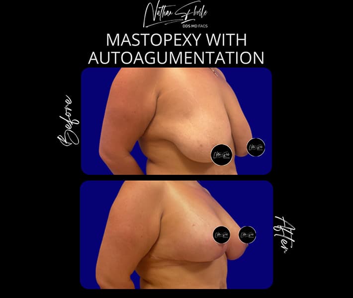Mastopexy before and after result 4, actual patient at Weston Center for Plastic Surgery