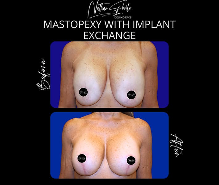 Mastopexy before and after result 5, actual patient at Weston Center for Plastic Surgery