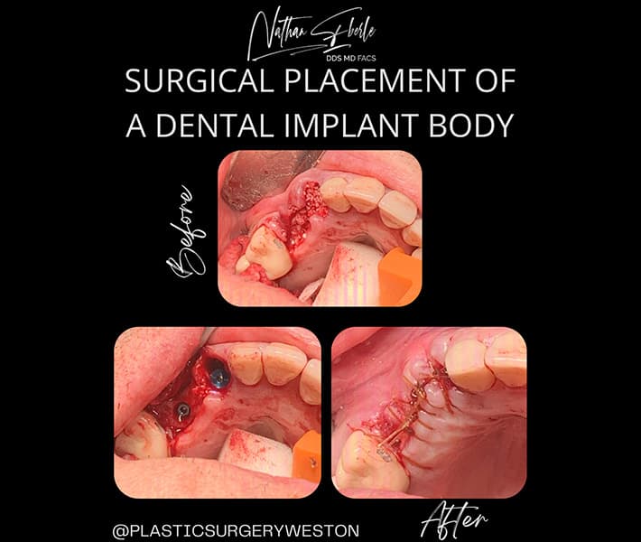 Oral Surgical Placement of Implant before and after result 1, actual patient at Weston Center for Plastic Surgery