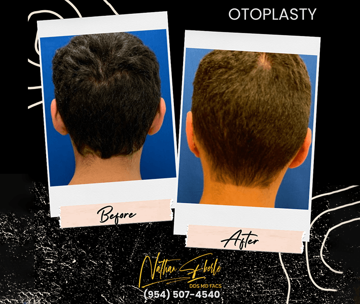 Otoplasty before and after: Ear repositioning and contour refinement.