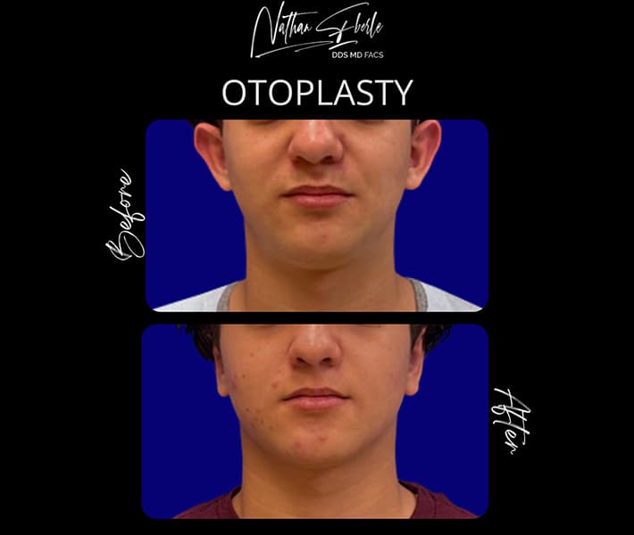 Otoplasty before and after case 10, actual patient at Weston Center for Plastic Surgery