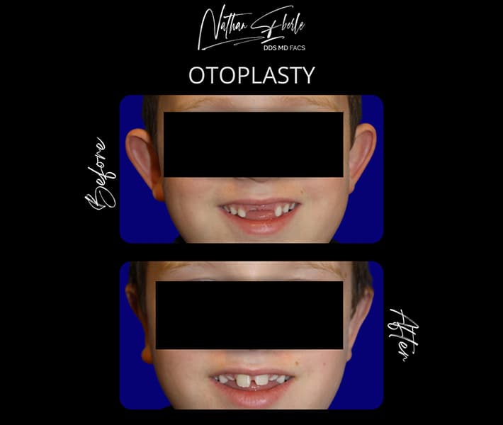 Otoplasty before and after case 11, actual patient at Weston Center for Plastic Surgery