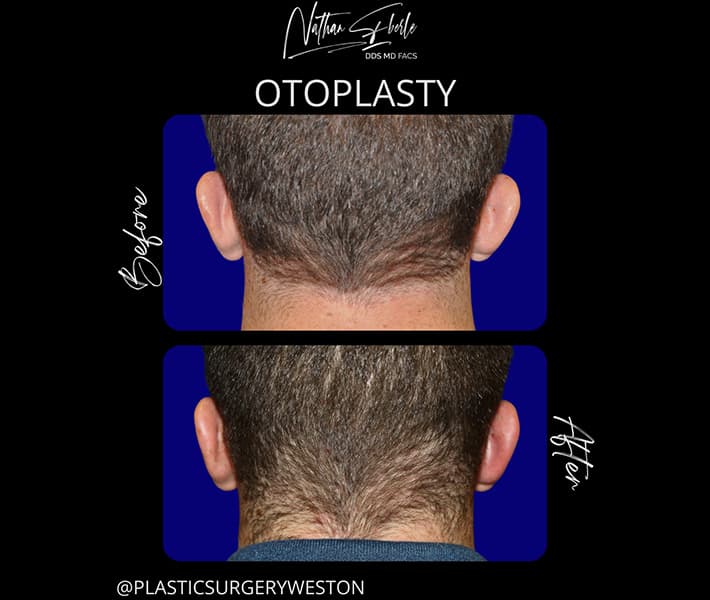 Otoplasty before and after case 12, actual patient at Weston Center for Plastic Surgery