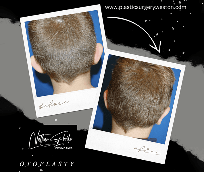 Otoplasty before and after: Improved proportion and symmetry.