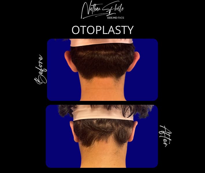Otoplasty before and after: Prominent ear correction.