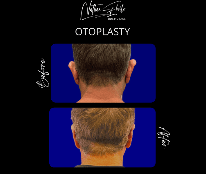 Otoplasty before and after: Natural-looking ear position.