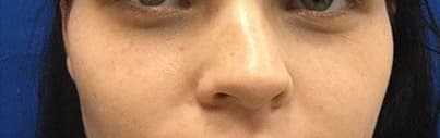 Rhinoplasty before and after case 1, actual patient at Weston Center for Plastic Surgery