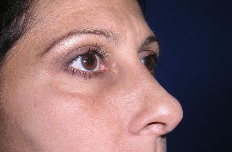 Rhinoplasty before and after case 3, actual patient at Weston Center for Plastic Surgery