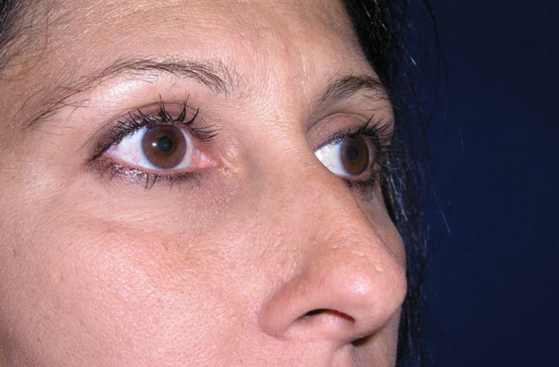 Rhinoplasty before and after case 4, actual patient at Weston Center for Plastic Surgery