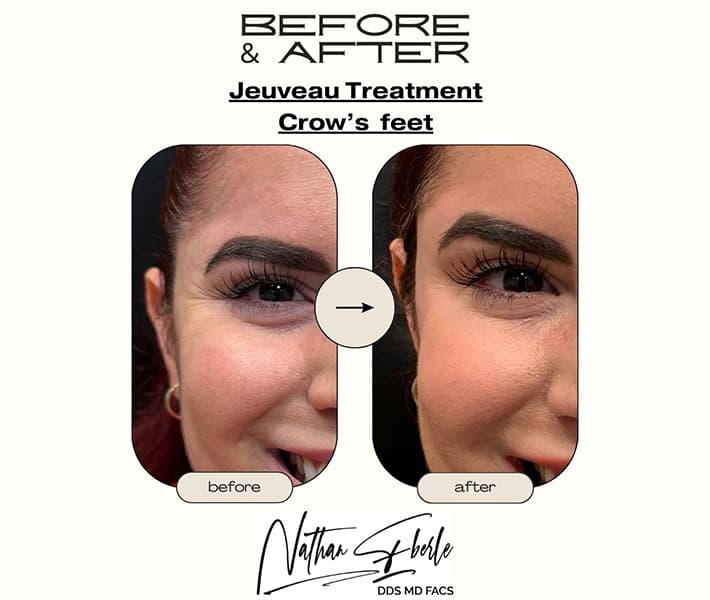 Toxin before and after result 2, actual patient at Weston Center for Plastic Surgery