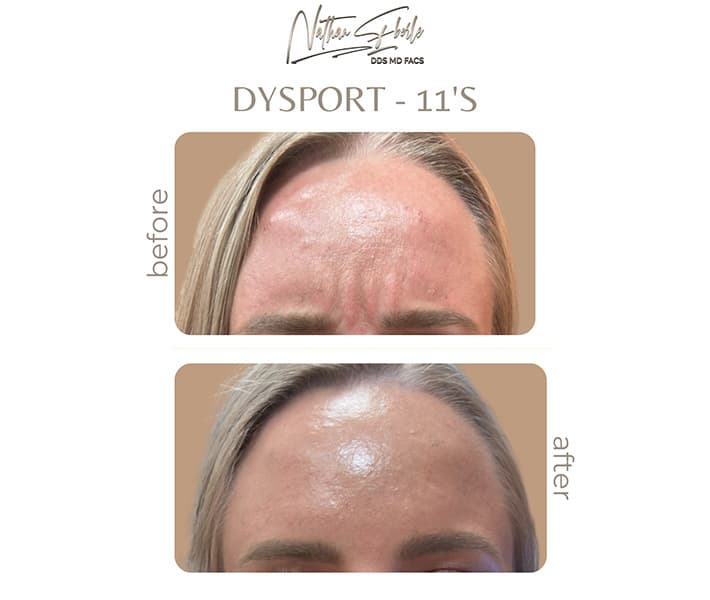 Toxin before and after result 3, actual patient at Weston Center for Plastic Surgery