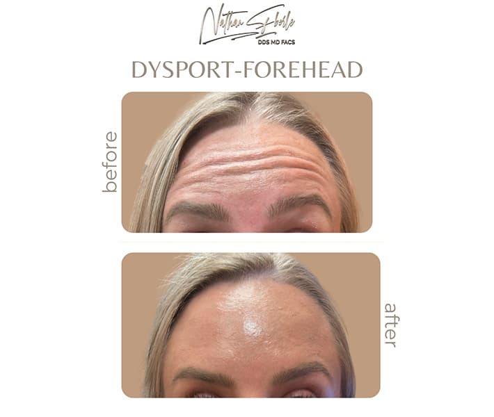 Toxins before and after result 2, actual patient at Weston Center for Plastic Surgery