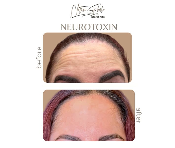 Toxins before and after result 4, actual patient at Weston Center for Plastic Surgery