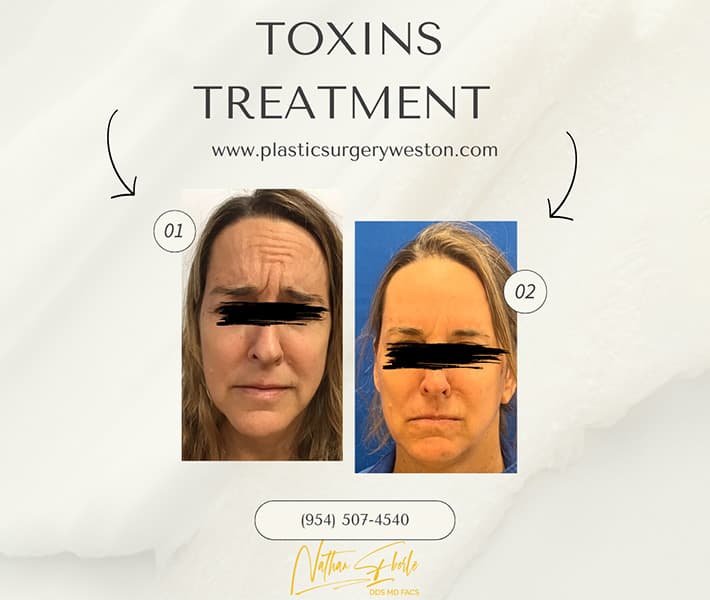 Toxins Treatment before and after result 1, actual patient at Weston Center for Plastic Surgery