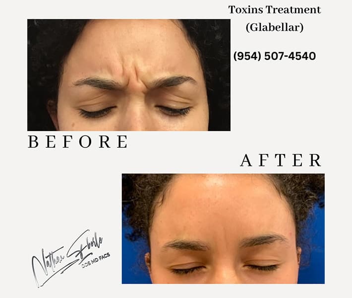 Toxins Treatment before and after result 2, actual patient at Weston Center for Plastic Surgery