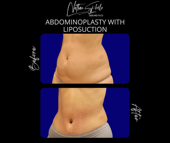 Tummy tuck before and after result