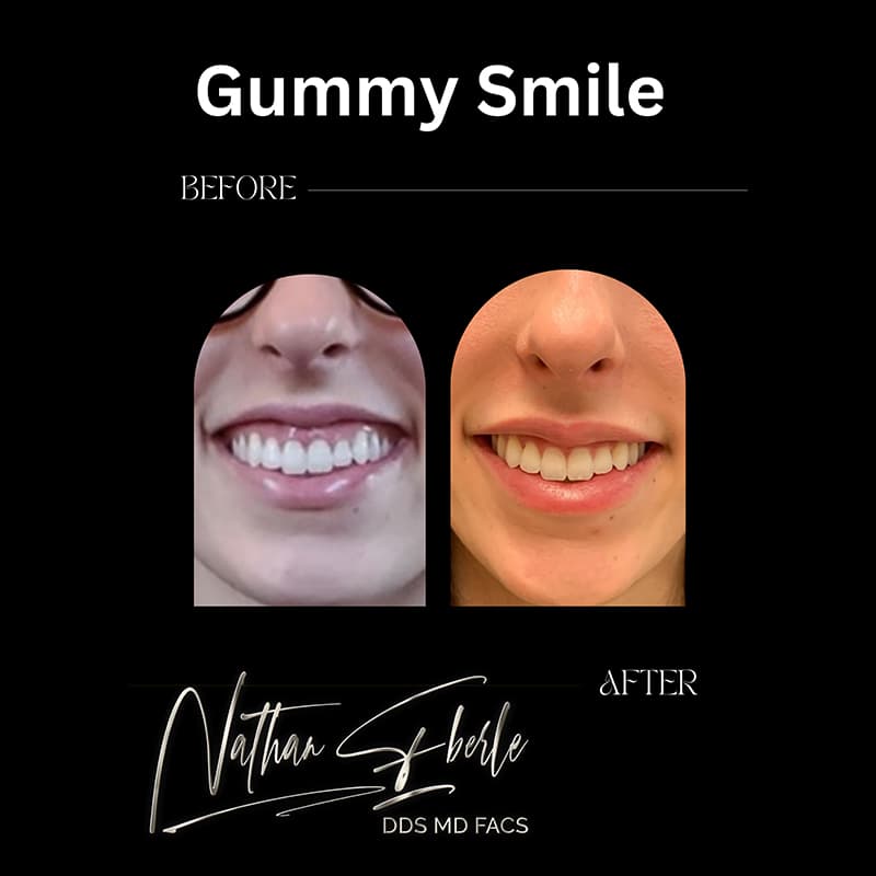 Gummy Smile before and after case 1, actual patient at Weston Center for Plastic Surgery