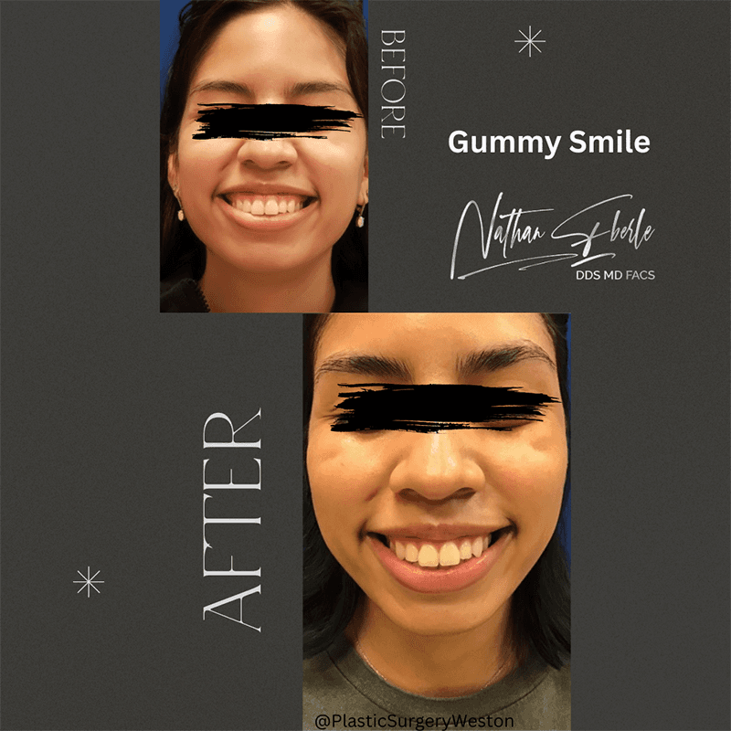 Gummy Smile before and after case 2, actual patient at Weston Center for Plastic Surgery