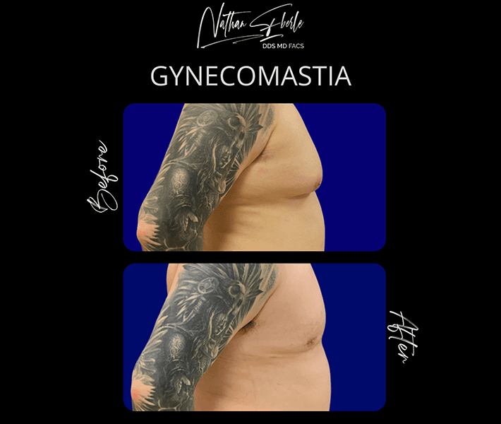 Gynecomastia before and after case 1, actual patient at Weston Center for Plastic Surgery