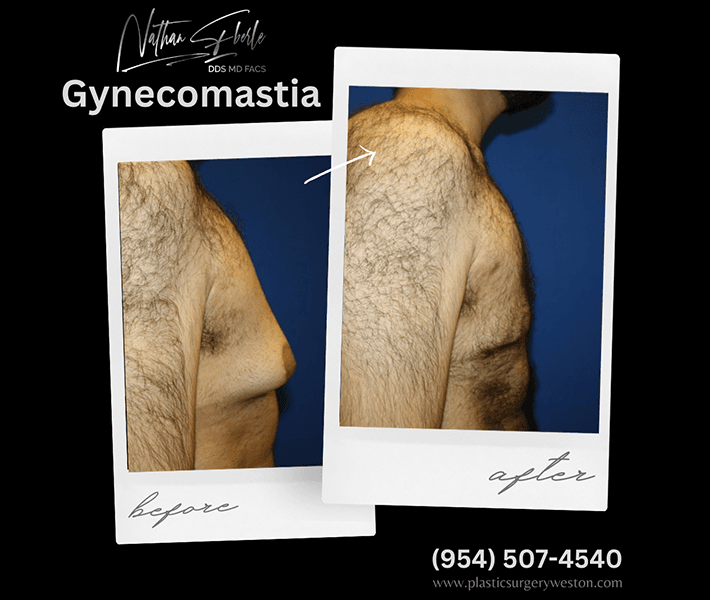 Gynecomastia before and after case 10, actual patient at Weston Center for Plastic Surgery