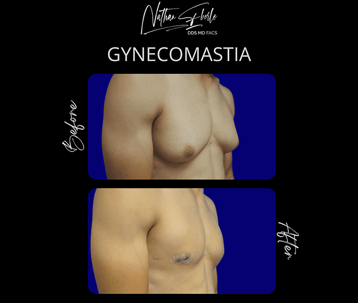 Gynecomastia before and after case 11, actual patient at Weston Center for Plastic Surgery