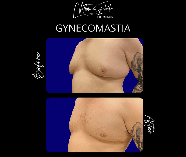 Gynecomastia before and after case 12, actual patient at Weston Center for Plastic Surgery