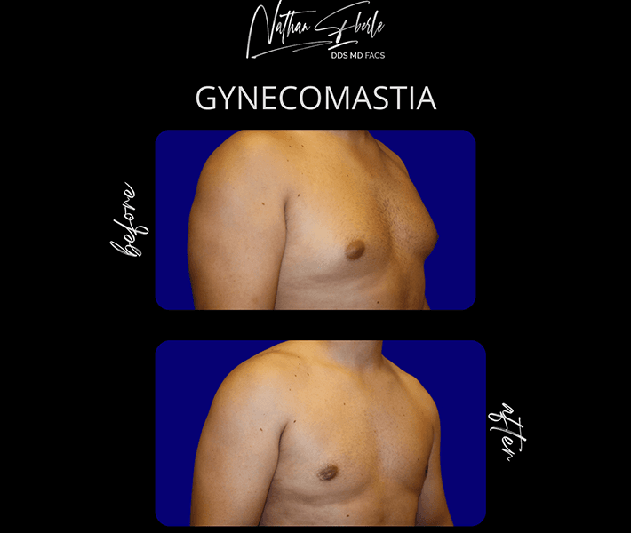 Gynecomastia before and after case 13, actual patient at Weston Center for Plastic Surgery