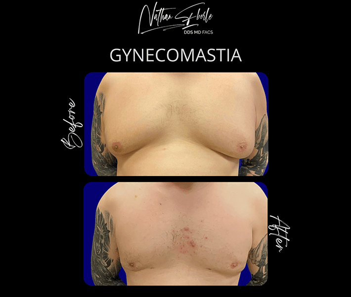 Gynecomastia before and after case 14, actual patient at Weston Center for Plastic Surgery