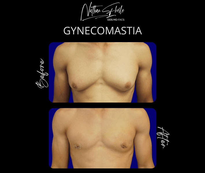 Gynecomastia before and after case 15, actual patient at Weston Center for Plastic Surgery