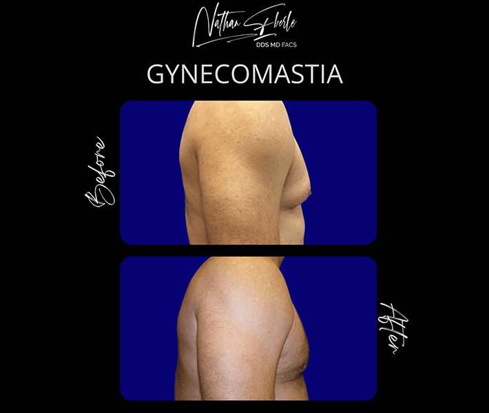 Gynecomastia before and after case 16, actual patient at Weston Center for Plastic Surgery