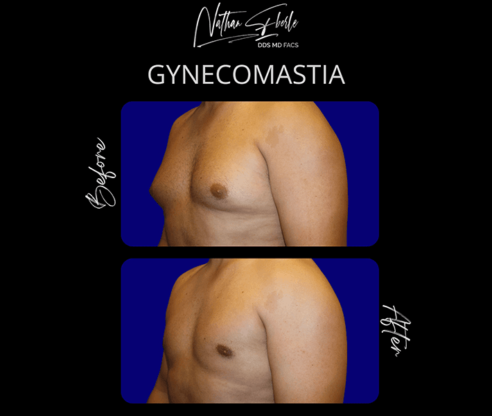 Gynecomastia before and after case 17, actual patient at Weston Center for Plastic Surgery