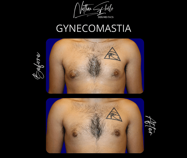 Gynecomastia before and after case 18, actual patient at Weston Center for Plastic Surgery