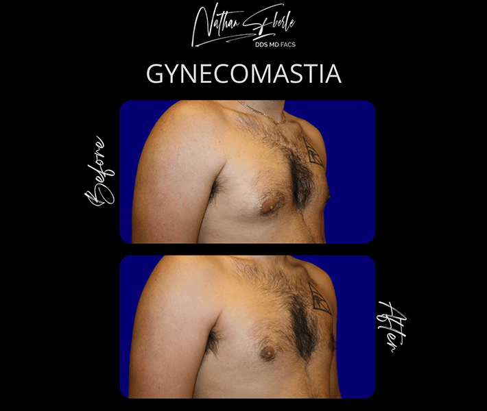 Gynecomastia before and after case 19, actual patient at Weston Center for Plastic Surgery