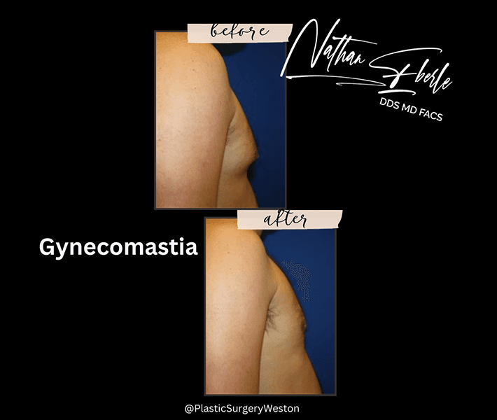 Gynecomastia before and after case 2, actual patient at Weston Center for Plastic Surgery