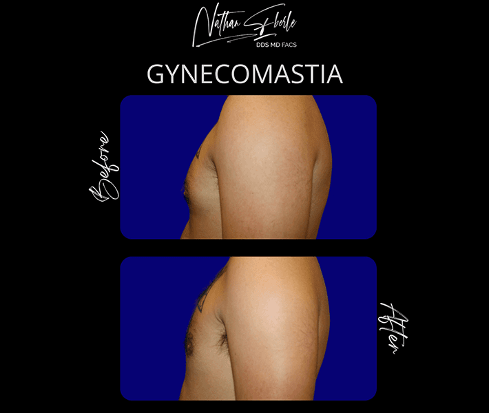 Gynecomastia before and after case 21, actual patient at Weston Center for Plastic Surgery