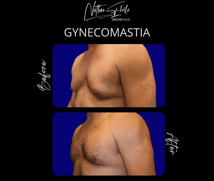 Gynecomastia before and after case 22, actual patient at Weston Center for Plastic Surgery
