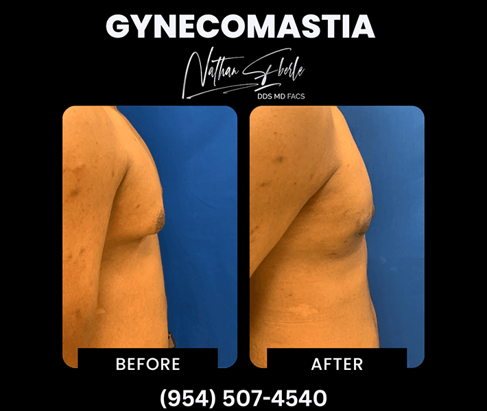 Gynecomastia before and after case 23, actual patient at Weston Center for Plastic Surgery