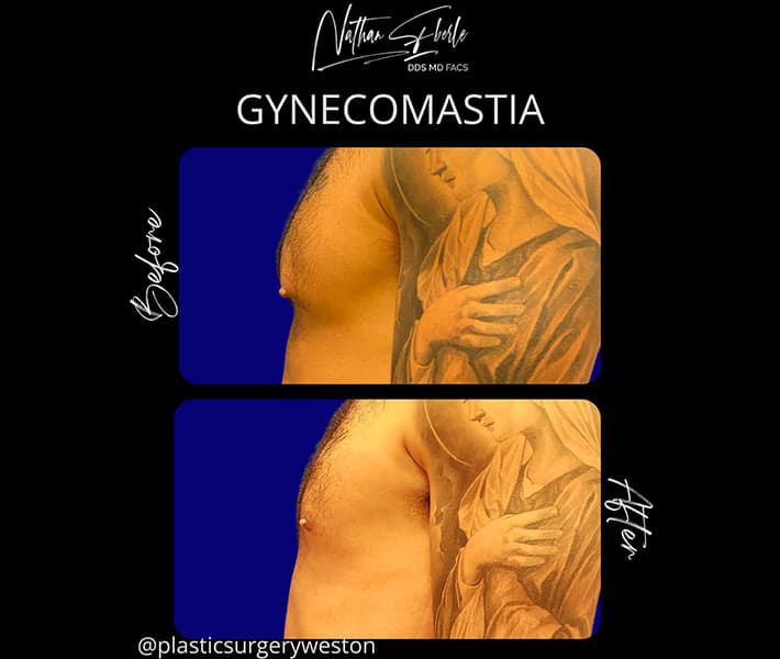 Gynecomastia before and after case 24, actual patient at Weston Center for Plastic Surgery