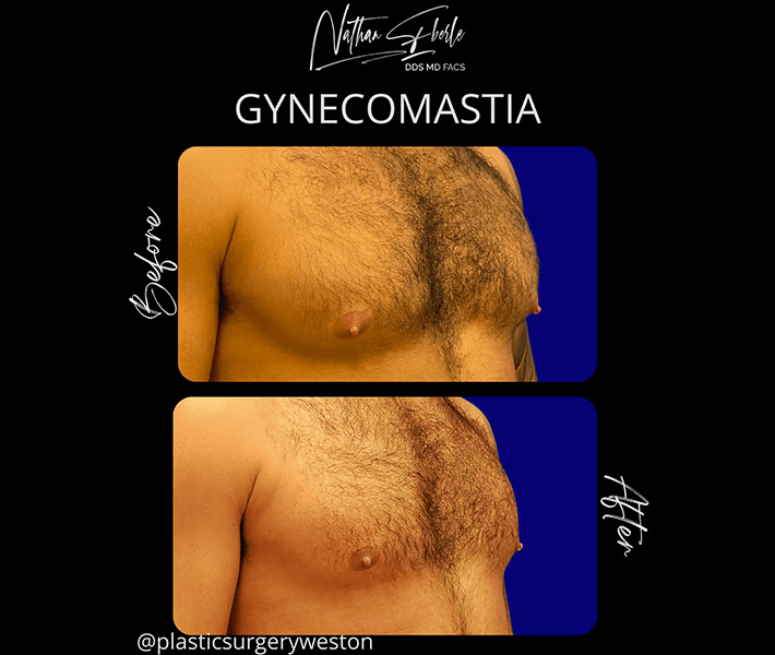 Gynecomastia case 25 before and after results at Weston Center for Plastic Surgery