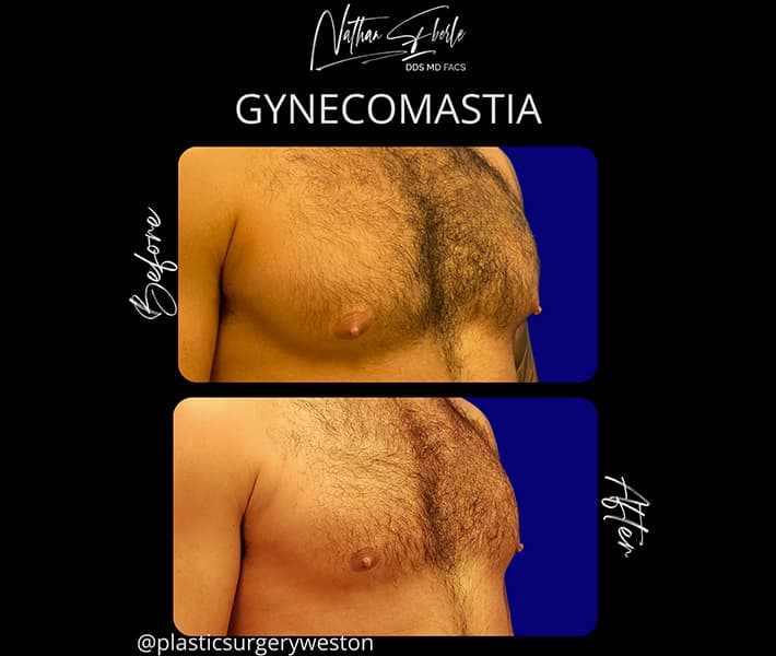 Gynecomastia before and after case 25, actual patient at Weston Center for Plastic Surgery